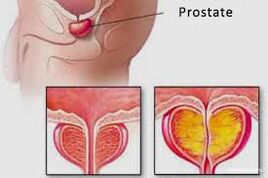prostata