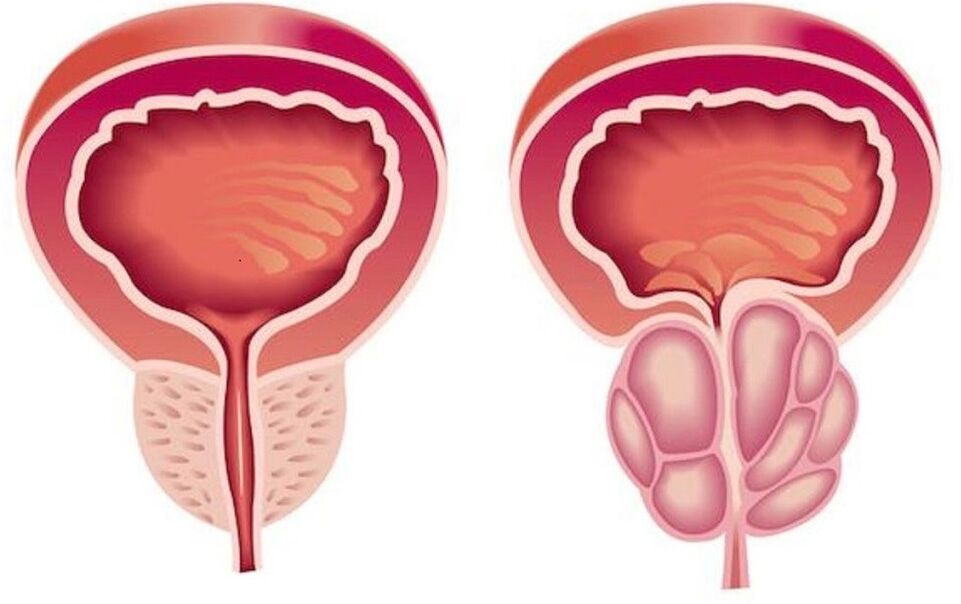 sveika ir uždegusi prostata su prostatitu